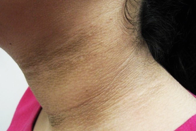 tanda prediabetes kulit leher hitam acanthosis nigricans akibat gula darah tinggi