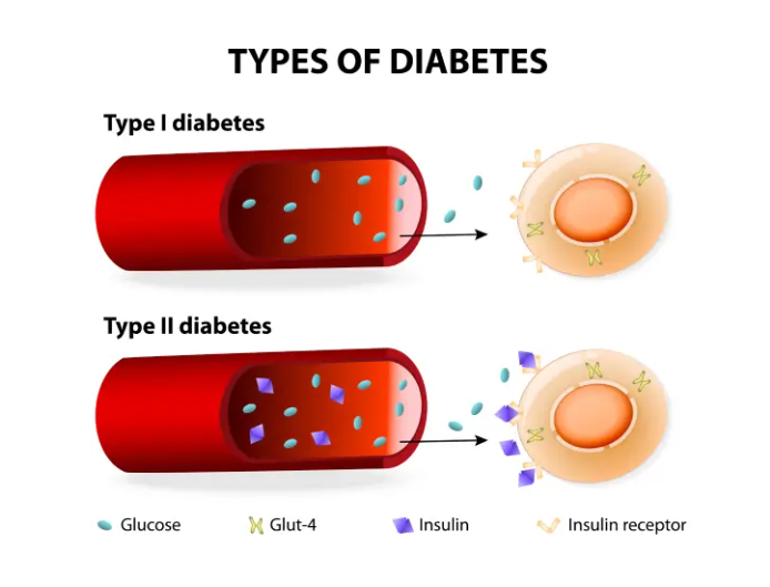 perbedaan dm tipe 1 vs tipe 2 ilustrasi insulin dan gula darah